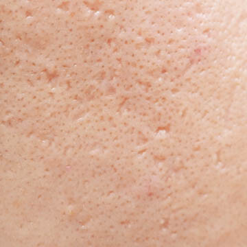 Acne Scarring Photo