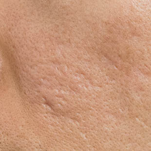 Acne Scarring Photo