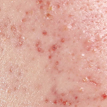 Active Acne Photo