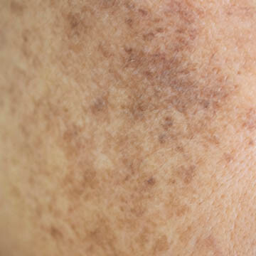 Age Spots Photo