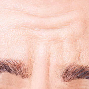 Compressed Frown Lines Photo