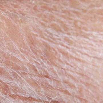 Dry Aging Skin
