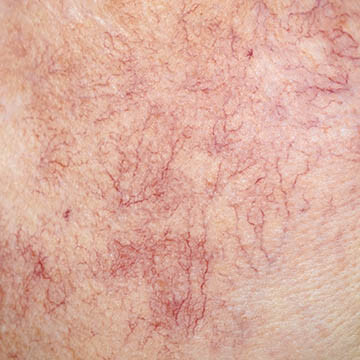 Erythematotelangiectatic Rosacea Photo