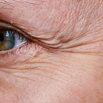 Eye Wrinkles Photo