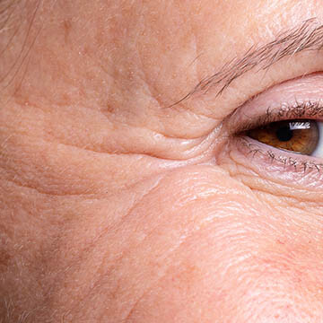 Fine Lines And Wrinkles Photo