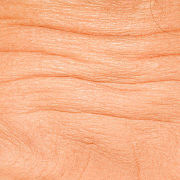 Forehead Furrows Photo