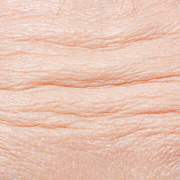 Forehead Lines Photo