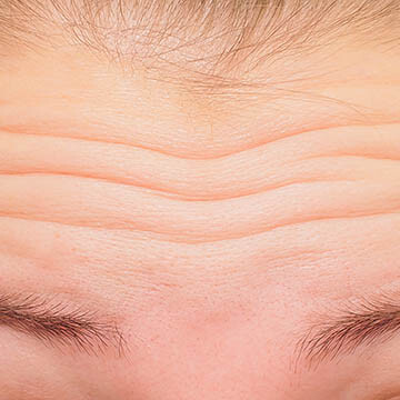 Forehead Wrinkles Photo