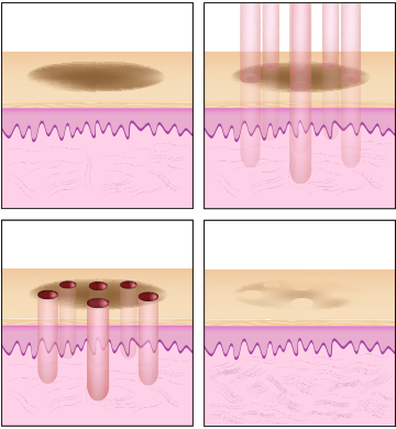 Fractional Laser Resurfacing Infographic
