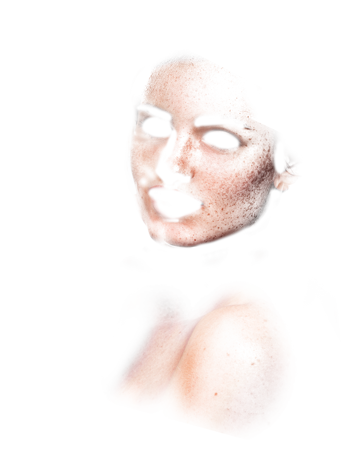 Fractional Laser Resurfacing Treatment Freckles