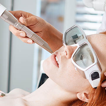 Fractional Laser Resurfacing Treatment