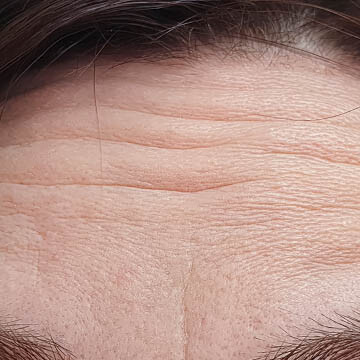 Glabellar Lines Photo