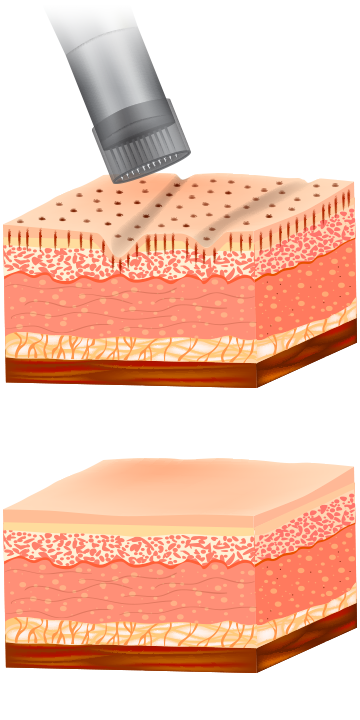 How Does Microneedling Work Infographic