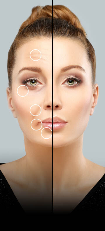 How Restylane Works Info Graphic