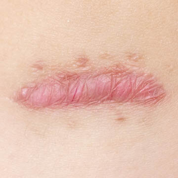Hypertrophic Scar Photo