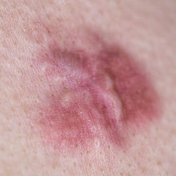 Keloid Scar Photo