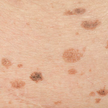 Liver Spots Photo