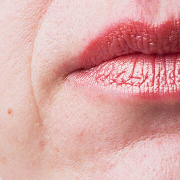 Marionette Lines Wrinkles Photo