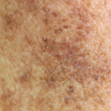 Melasma Photo