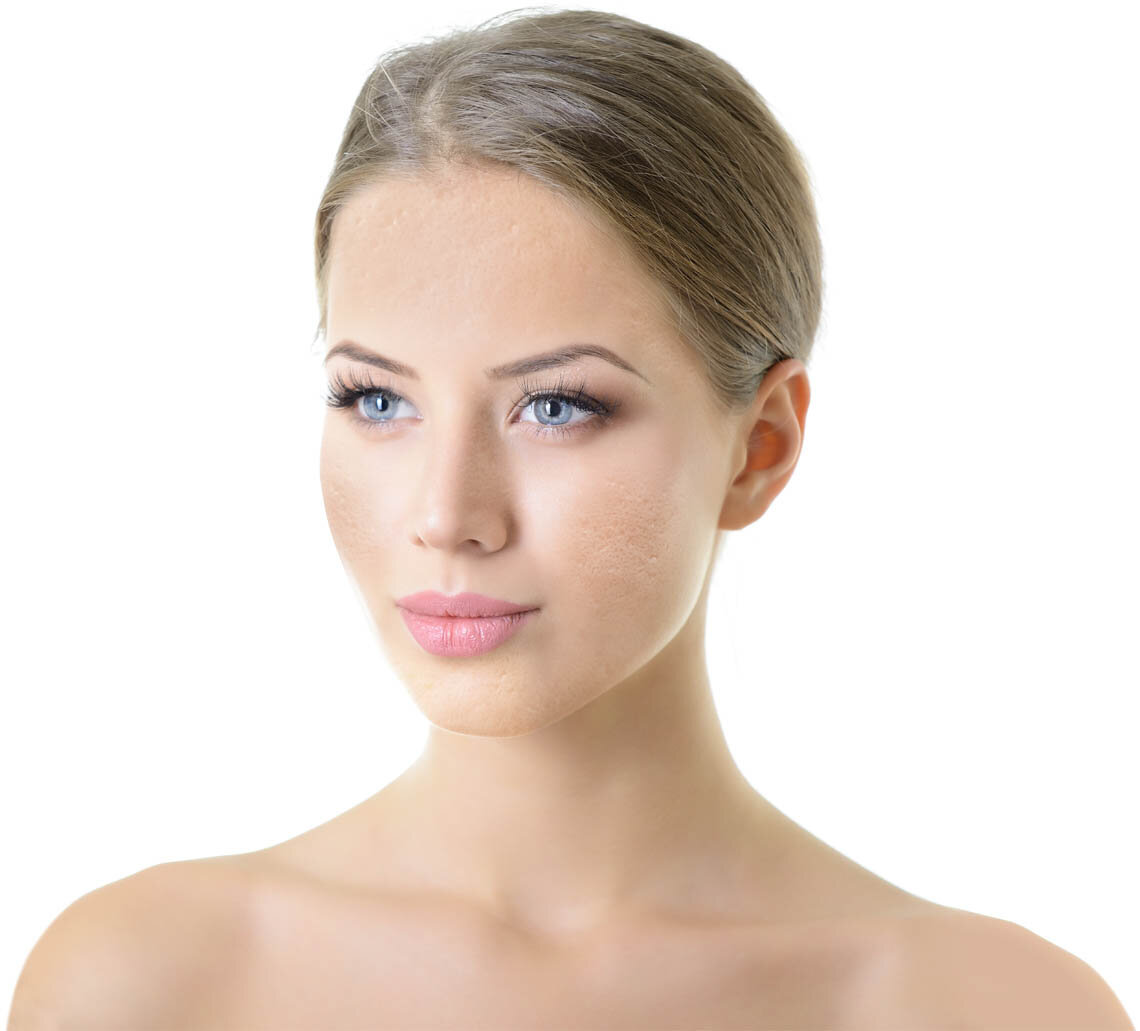 Microneedling Before Treatment Photo