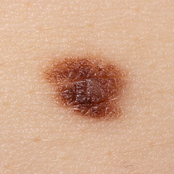 Mole or Blemish Photo