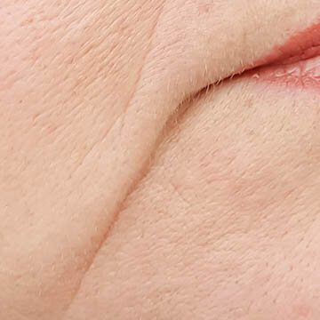 Mouth Wrinkles Photo