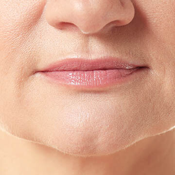 Nasolabial Folds Photo