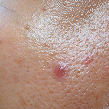 Oily Acne-Prone Skin Photo