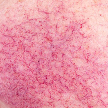Papulopustular Rosacea Photo