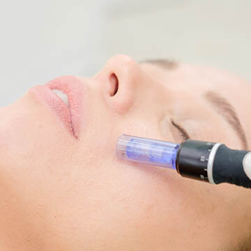 Photo of Microneedling Being Applied To Cheeks