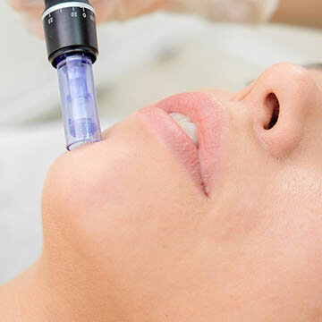 Photo of Microneedling Being Applied To Chin