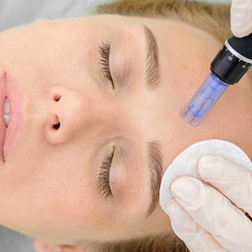 Photo of Microneedling Being Applied To Forehead