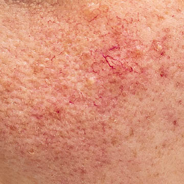Phymatous Rosacea Photo