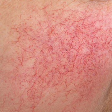 Rosacea Photo