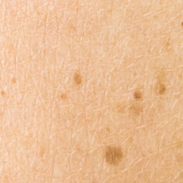 Solar Lentigines Photo