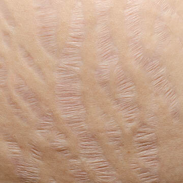 Stretch Mark Scars Photo