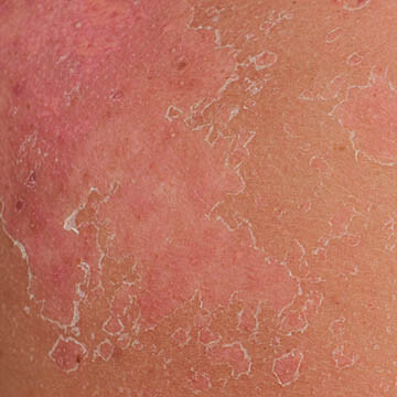 Sun Burned Skin Photo