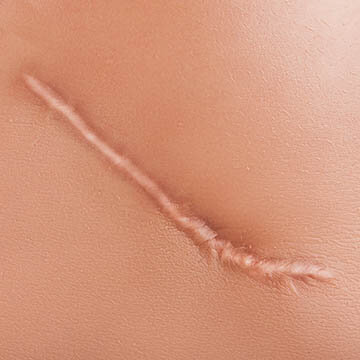 Surgical Scar Photo